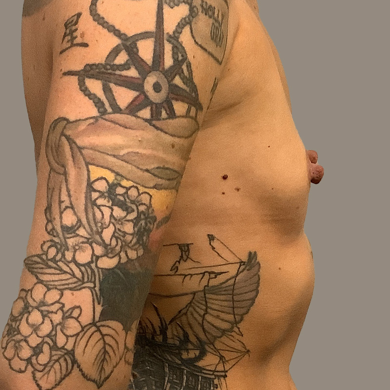 Breast Augmentation 03