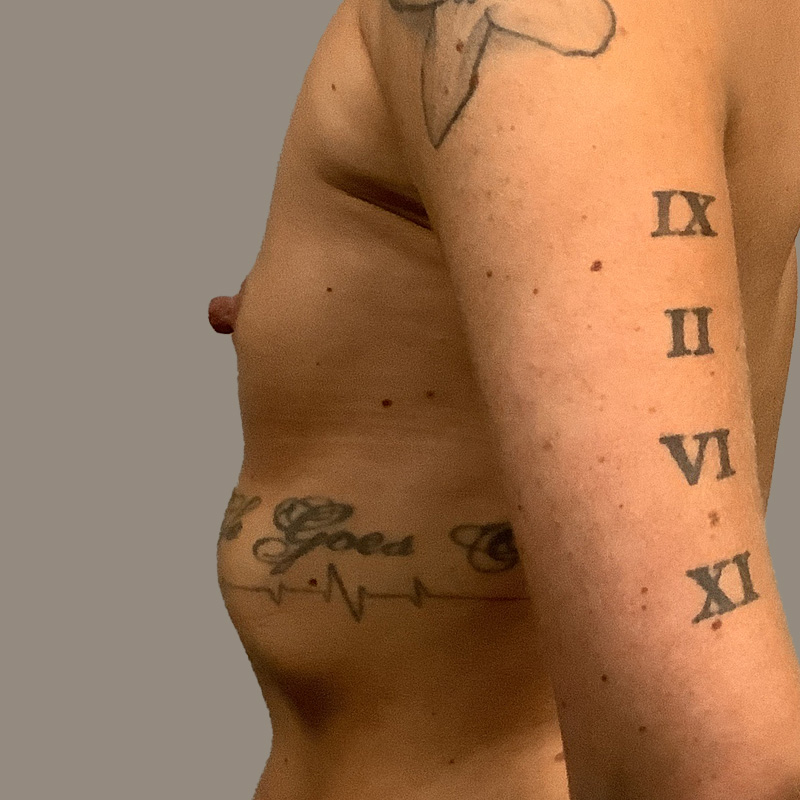 Breast Augmentation 05