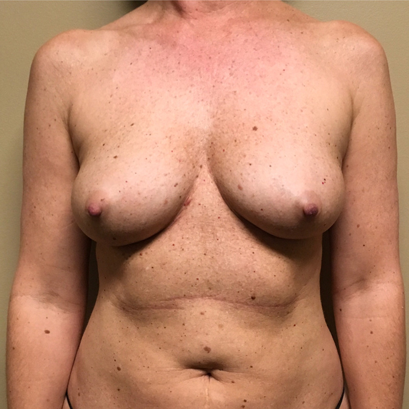 Breast Augmentation 01