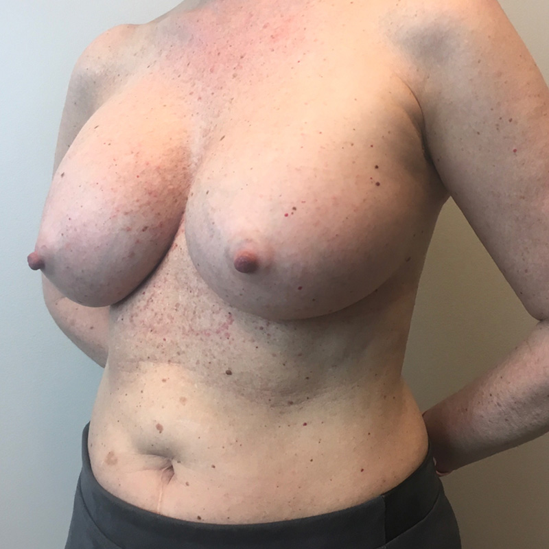 Breast Augmentation 03