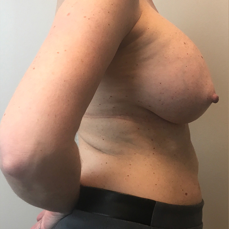 Breast Augmentation 05