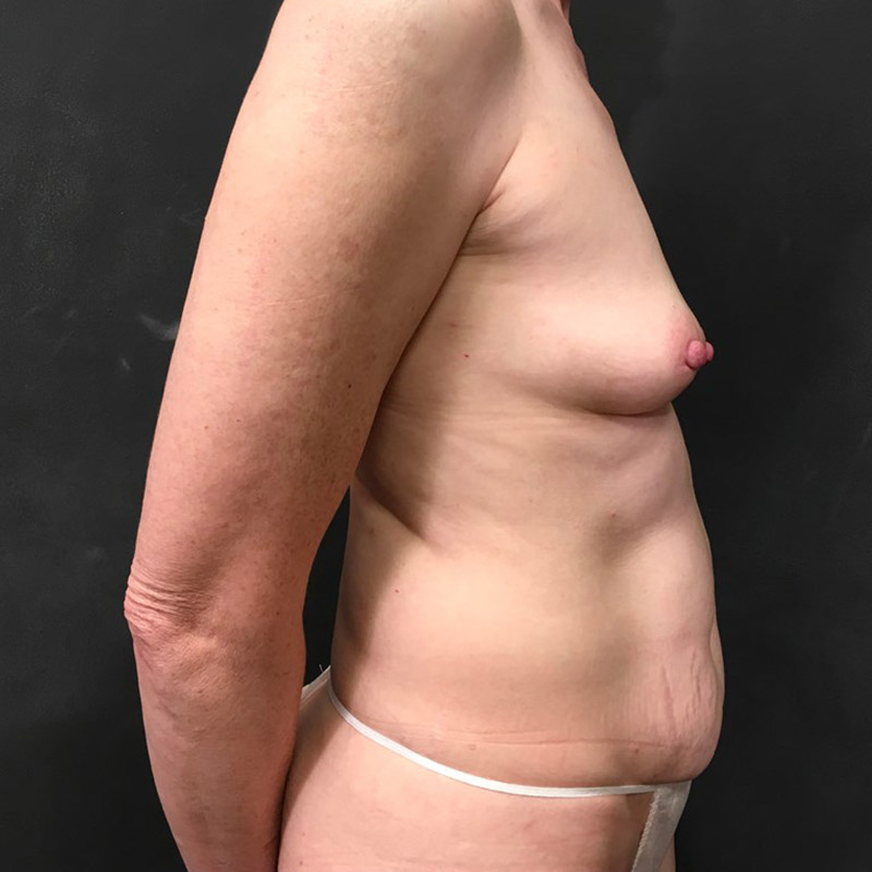 Breast Augmentation 05