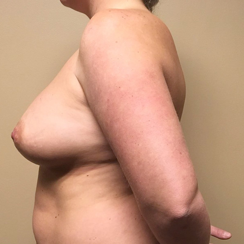 Breast Augmentation 05