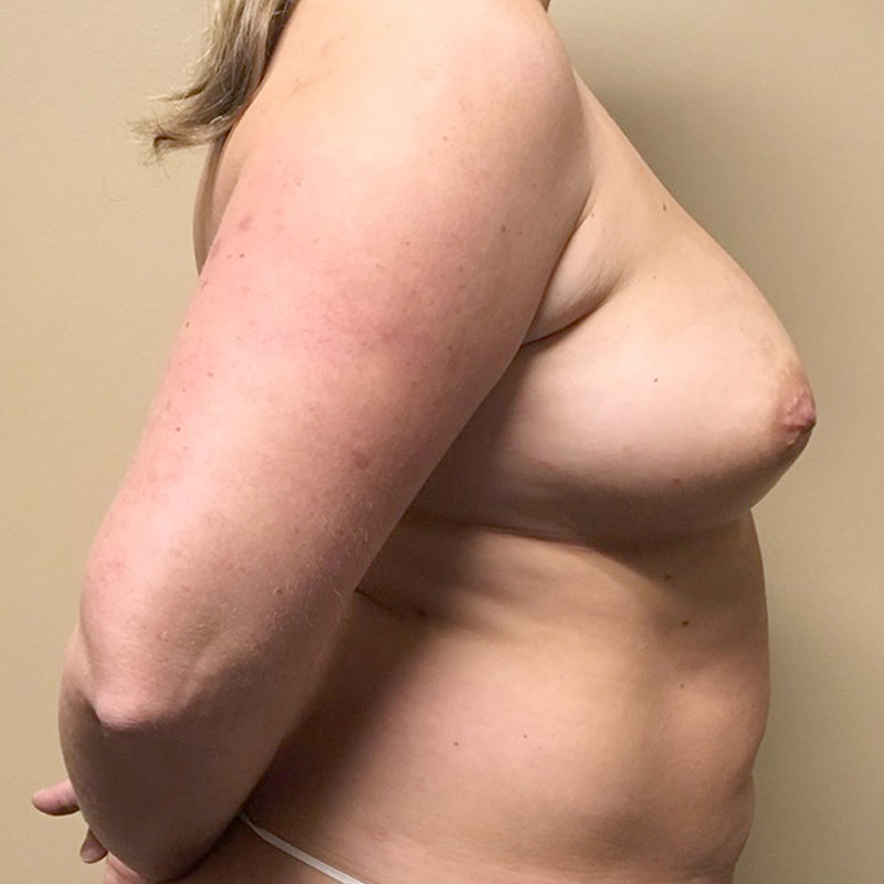 Breast Augmentation 07