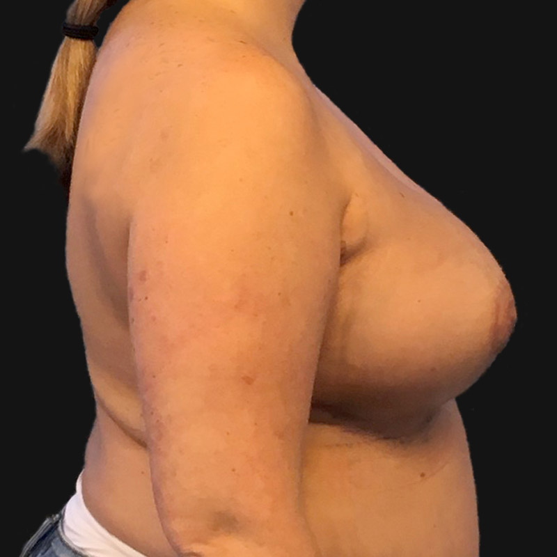 Breast Augmentation 07