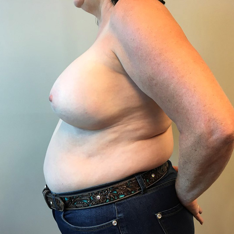 Breast Augmentation 03