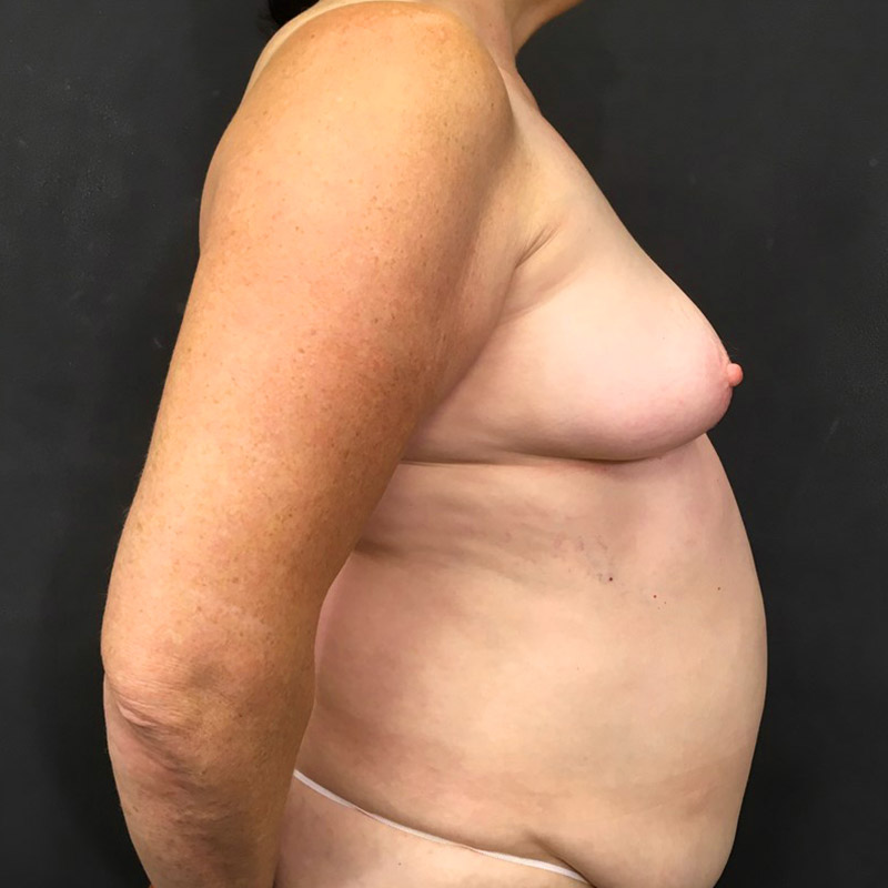 Breast Augmentation 07