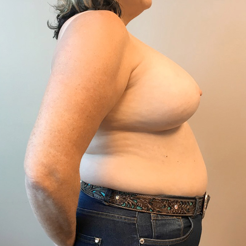 Breast Augmentation 07