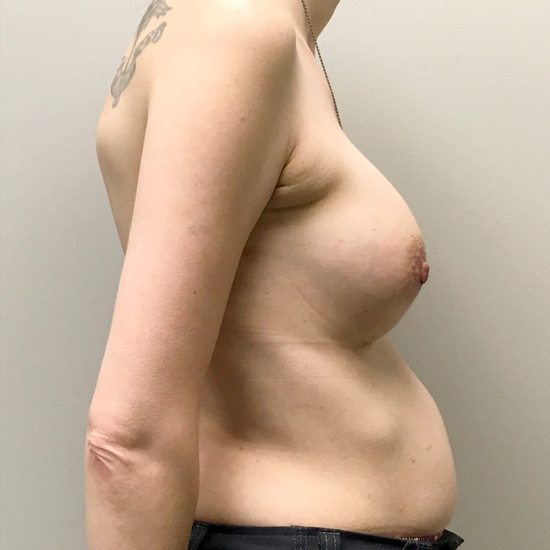 Breast Augmentation 05