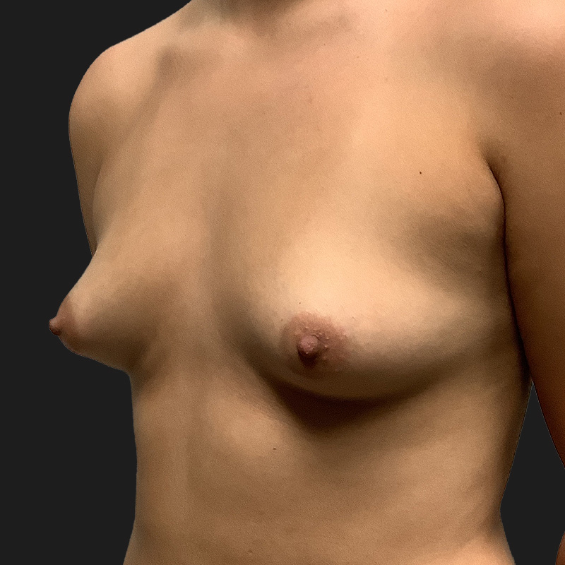 Breast Augmentation 03