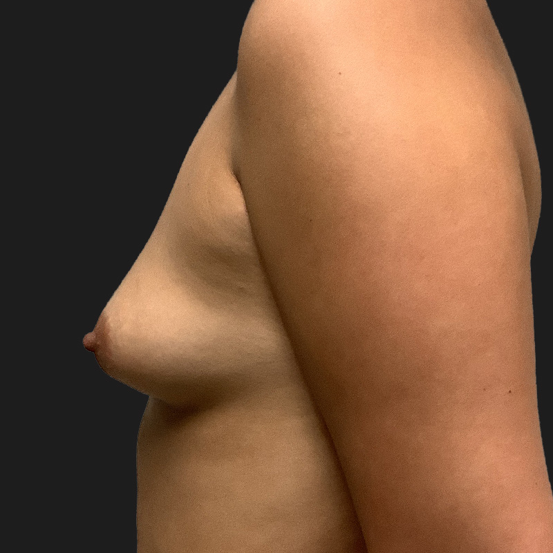 Breast Augmentation 05