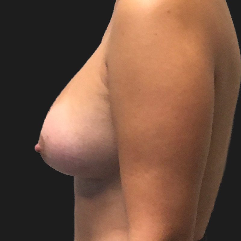 Breast Augmentation 05