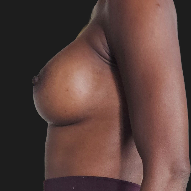 Breast Augmentation 03
