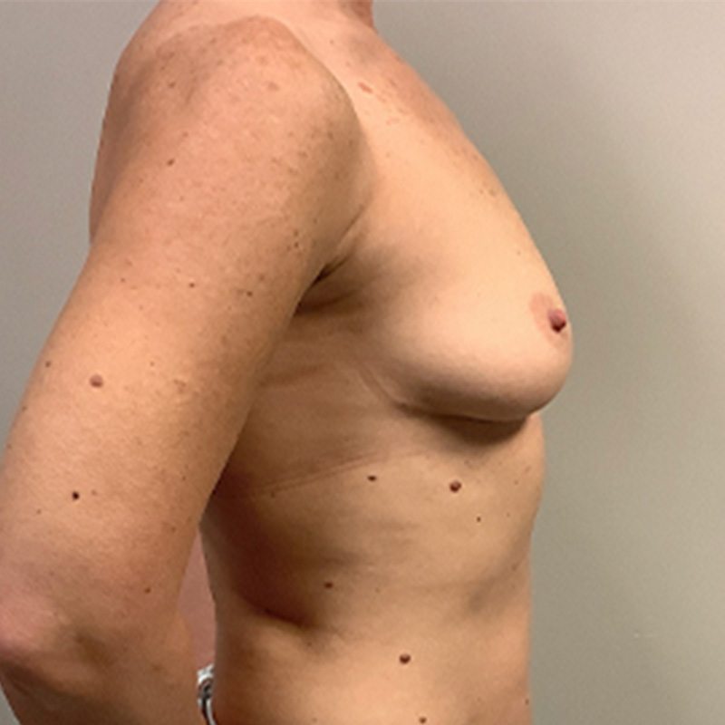 Breast Augmentation 05