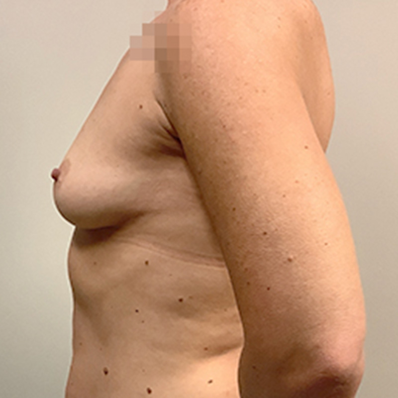 Breast Augmentation 09