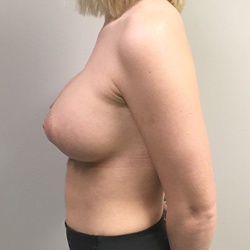 Breast Augmentation 05