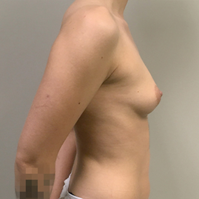 Breast Augmentation 09