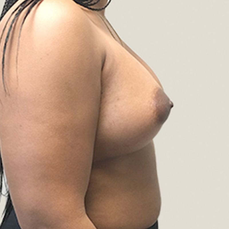 Breast Augmentation 09