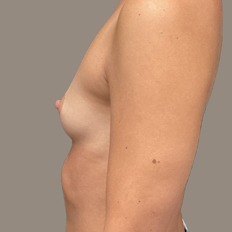 Breast Augmentation 05