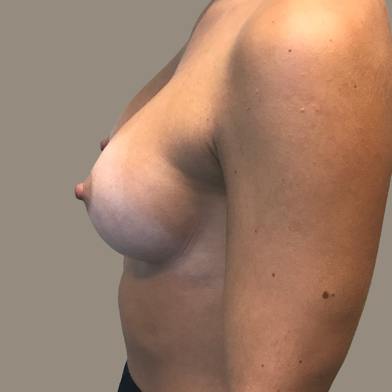 Breast Augmentation 05