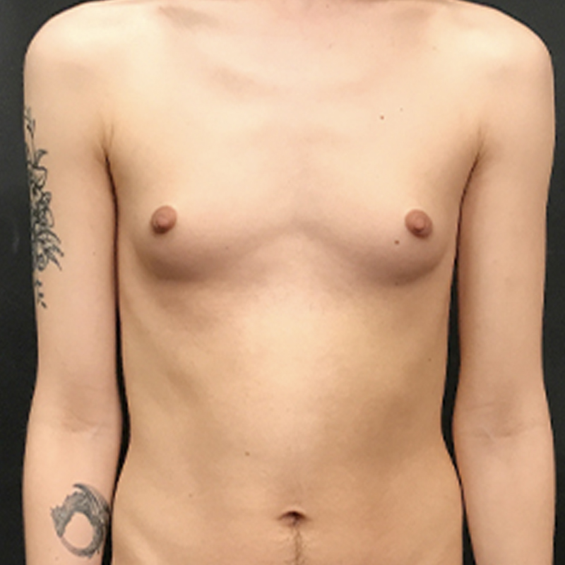 Breast Augmentation 01