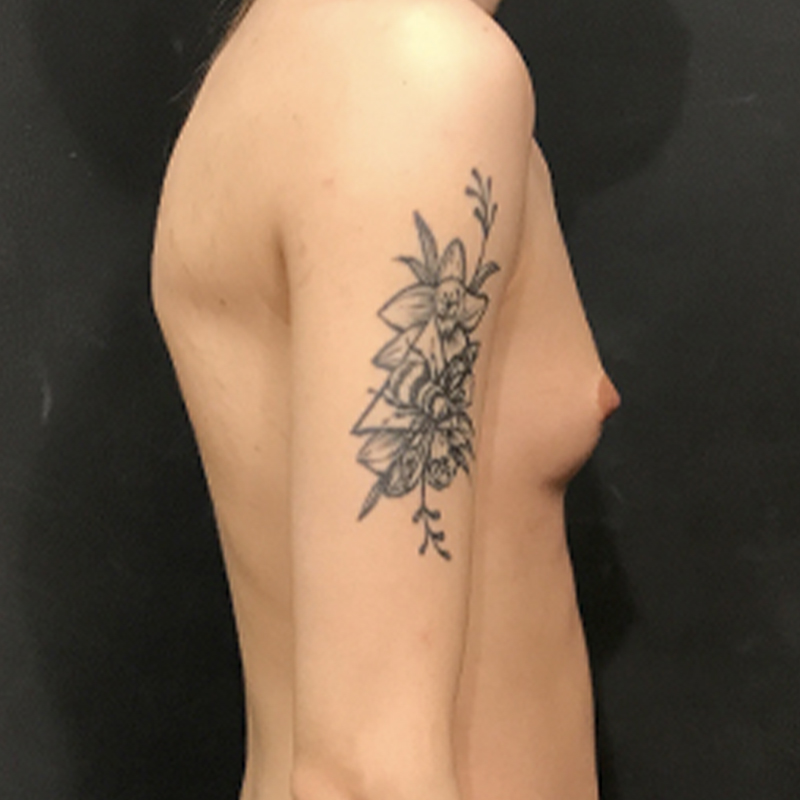 Breast Augmentation 09