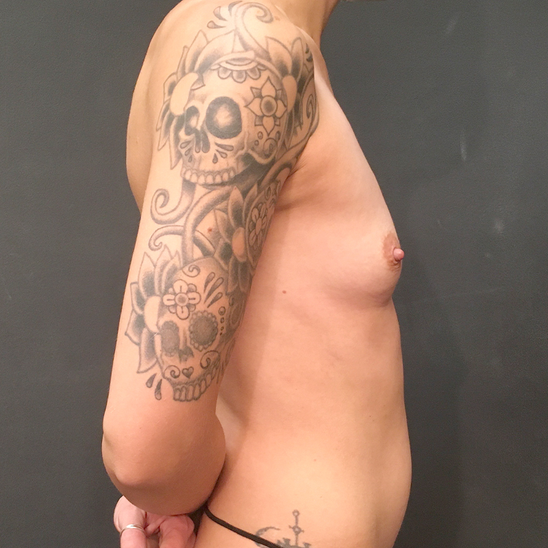 Breast Augmentation 01