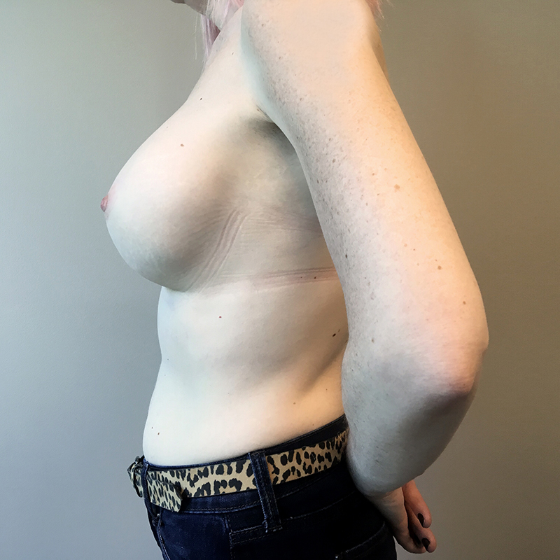 Breast Augmentation 03