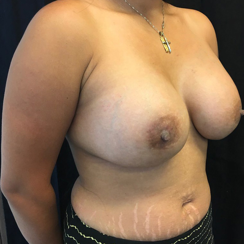 Breast Augmentation 03