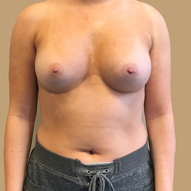 Breast Augmentation 47