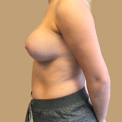 Breast Augmentation 05
