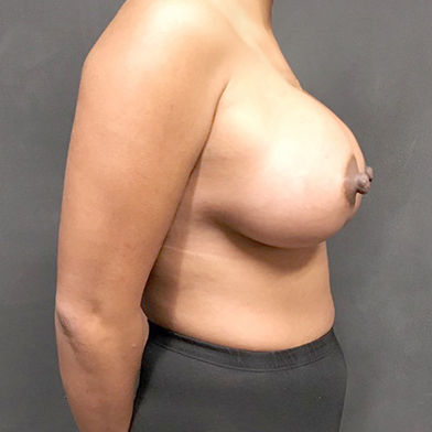 Breast Augmentation 07