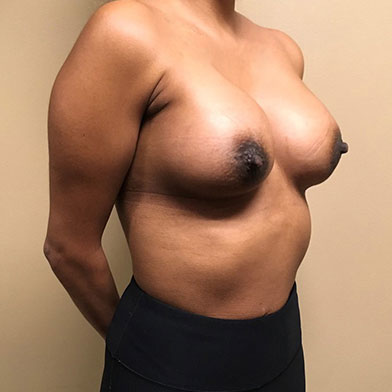 Breast Augmentation 05