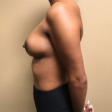 Breast Augmentation 09