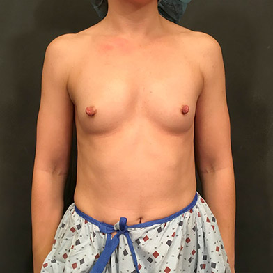 Breast Augmentation 01