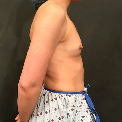 Breast Augmentation 09