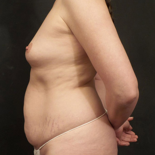 Breast Augmentation 03