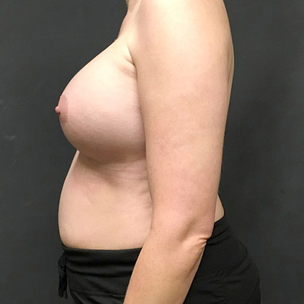 Breast Augmentation 03