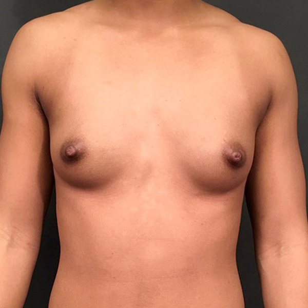 Breast Augmentation 01
