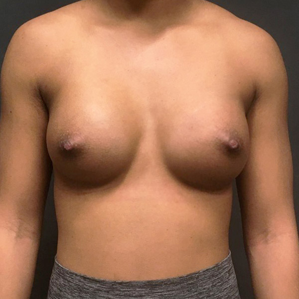 Breast Augmentation 54