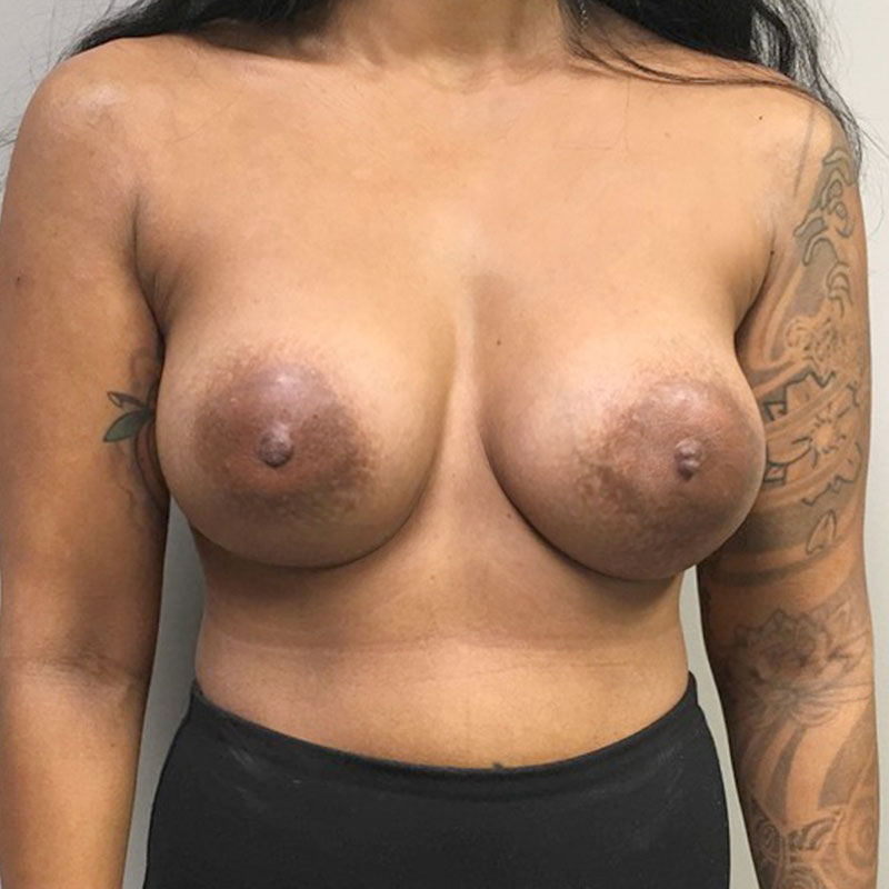 Breast Augmentation 56