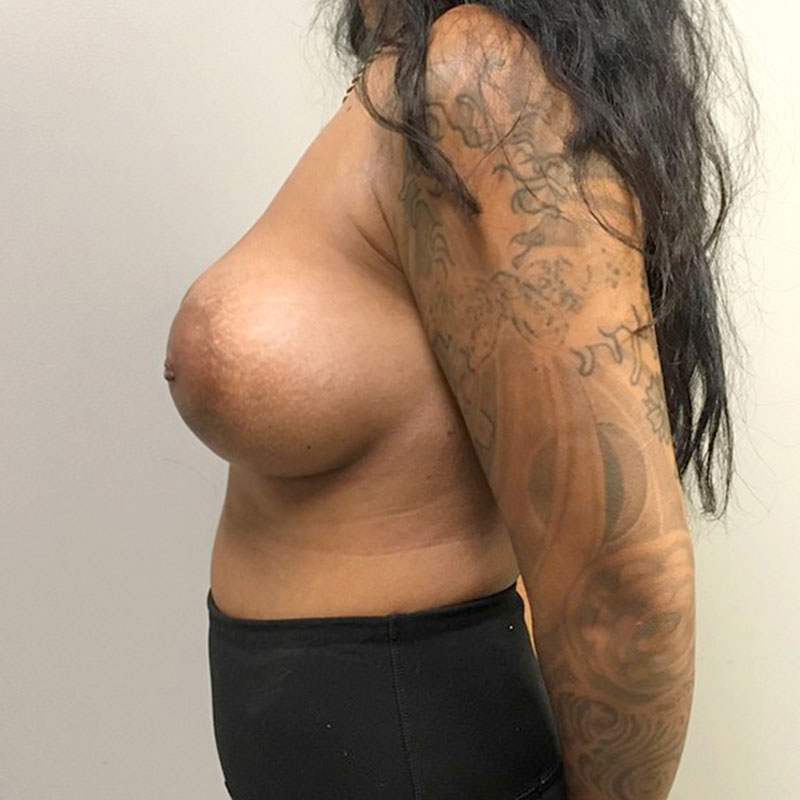 Breast Augmentation 05