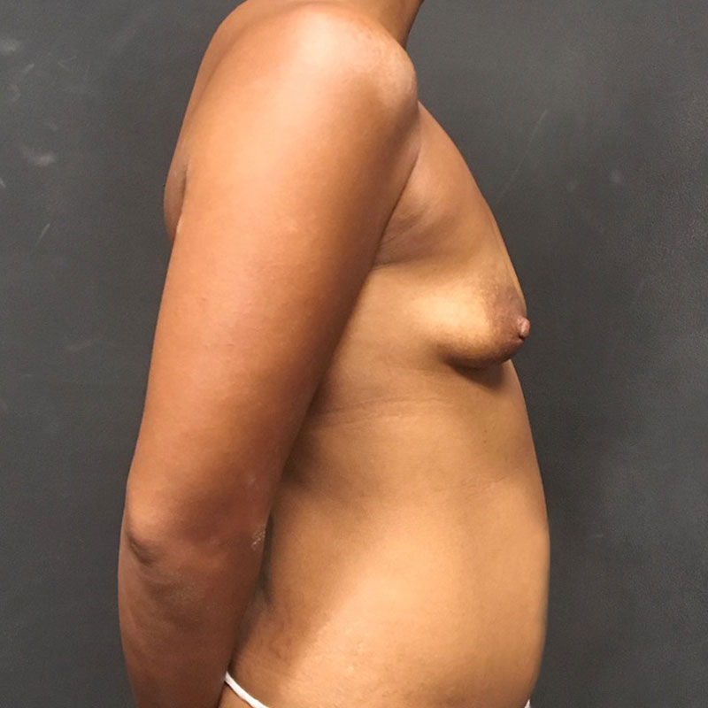 Breast Augmentation 09