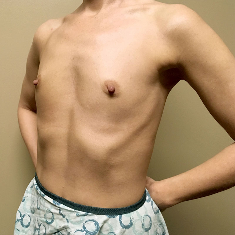 Breast Augmentation 03