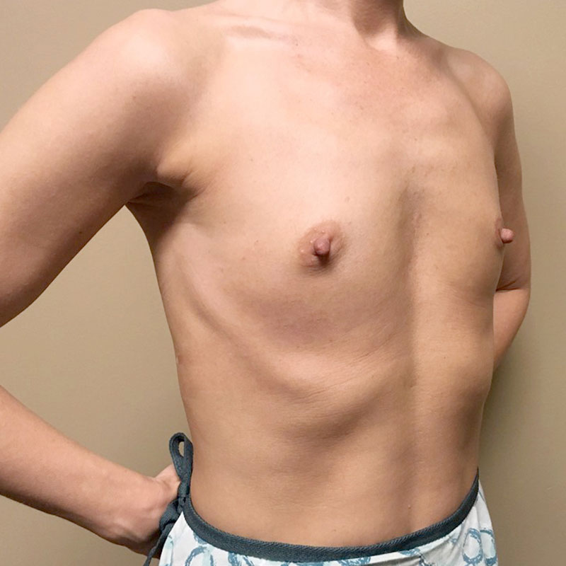 Breast Augmentation 07