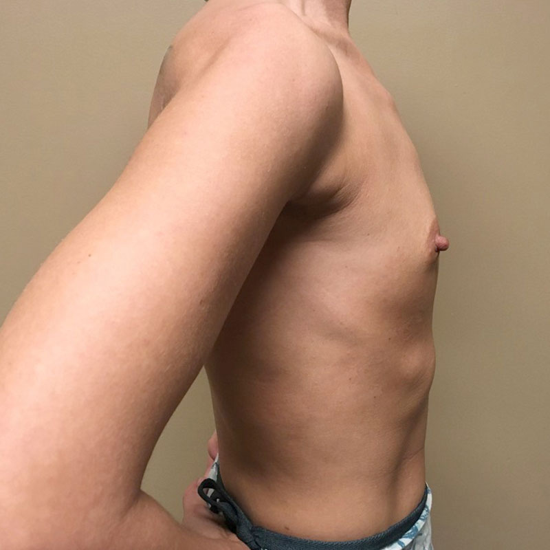 Breast Augmentation 09