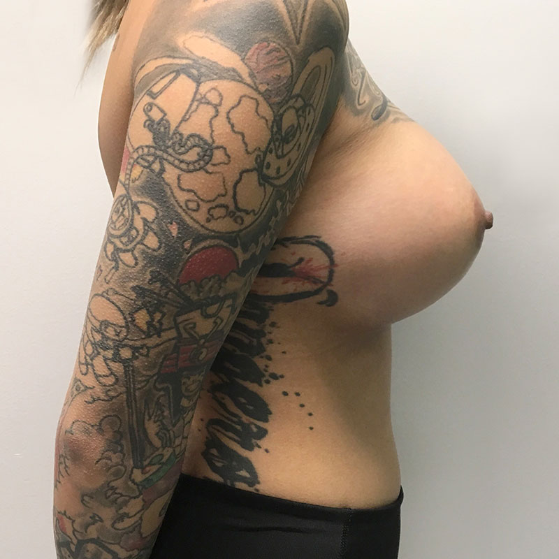 Breast Augmentation 07