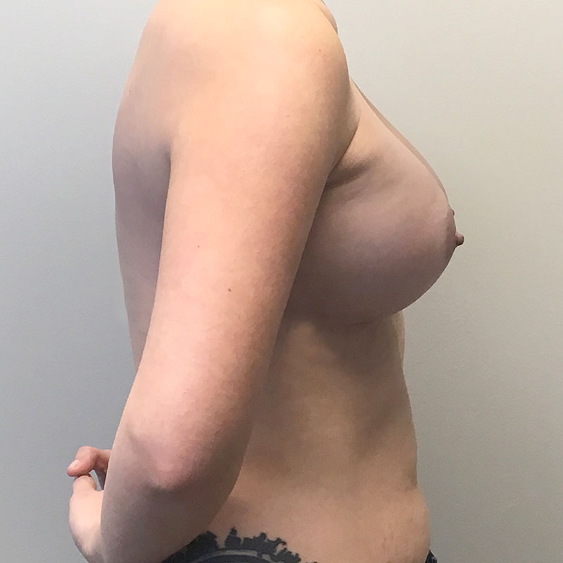 Breast Augmentation 07