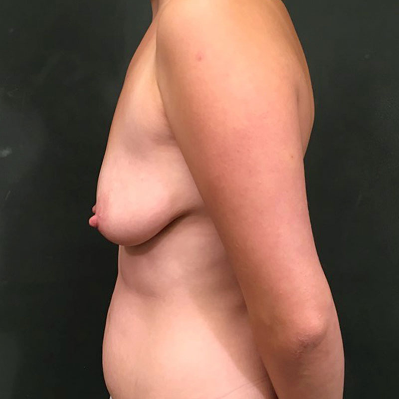 Breast Augmentation 05