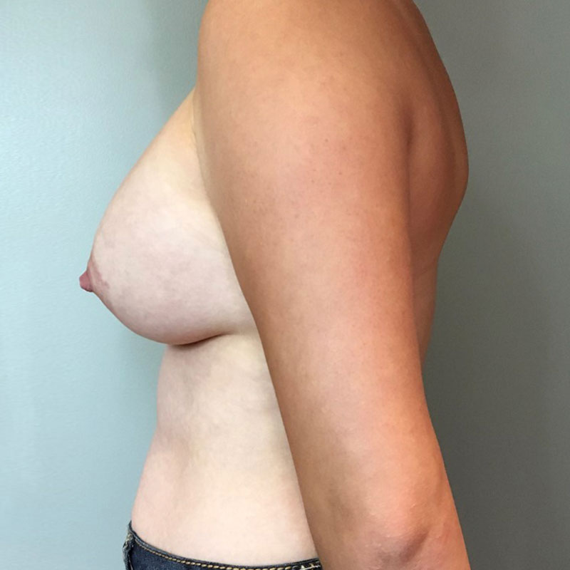 Breast Augmentation 05